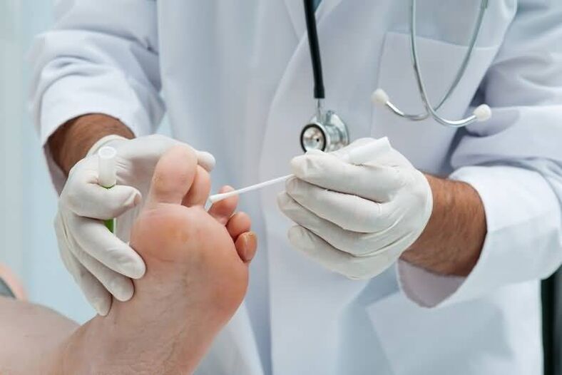 Se hai sintomi di fungo dell'unghia del piede, dovresti consultare un dermatologo o un micologo. 