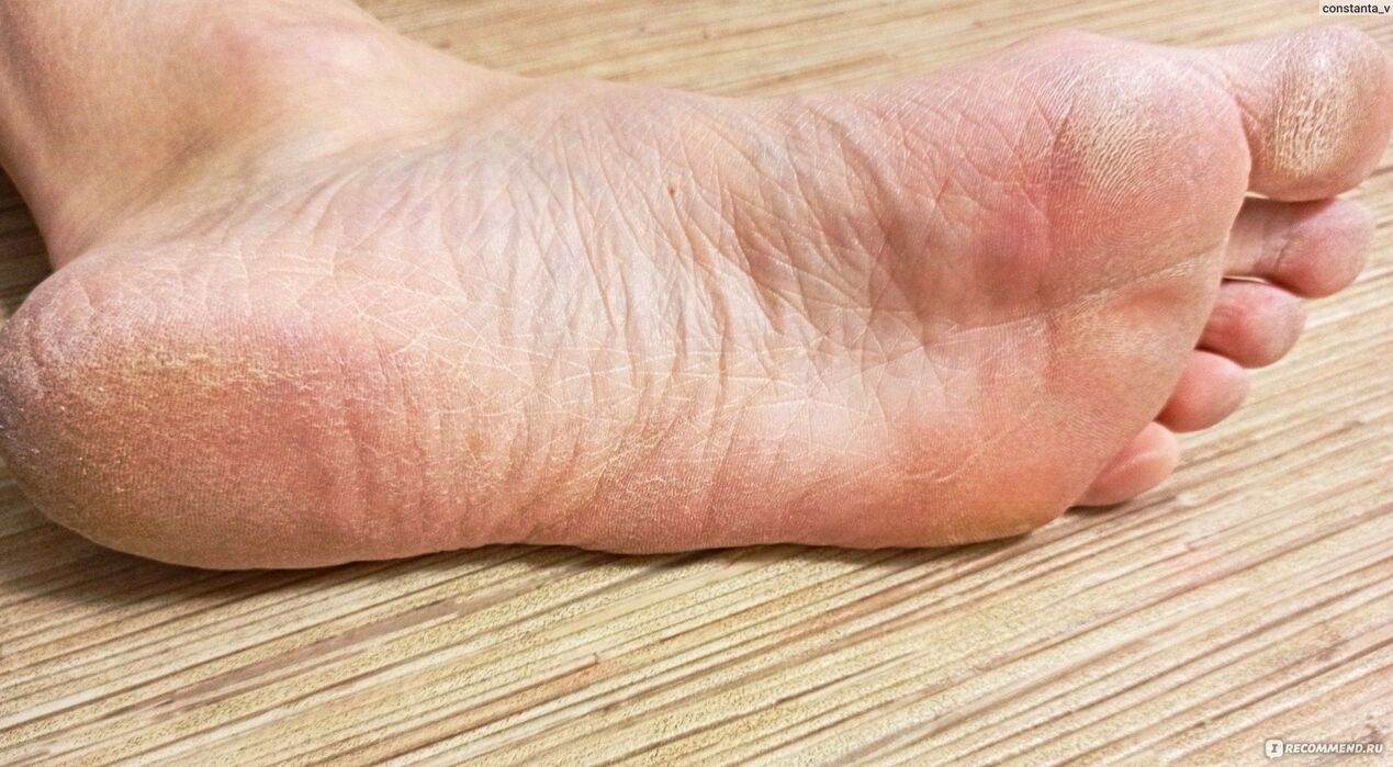 fungo sul piede umano